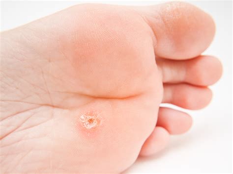 Toenail And Skin Problems Podiatrist Enfield And South Windsor Ct — Podiatrycare Pc And The