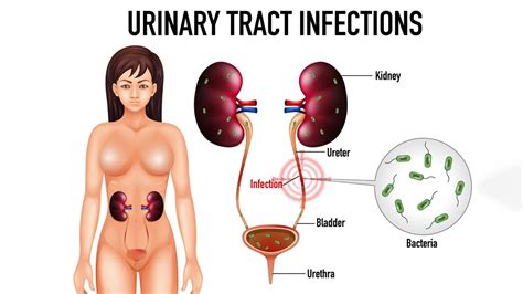 Uti Common Causes Of Urinary Tract Infection