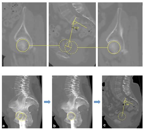 Comparison Of Pelvic Incidence Measurement Using Lateral X Ray