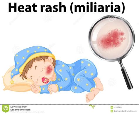 A Baby With Heat Rash Stock Vector Illustration Of Graphic 121990814
