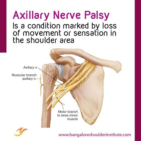 Shoulder Dislocation Shoulder Dislocation Nerve Palsy Shoulder