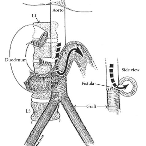 Drawing Of Aortoenteric Fistula At The Anastomosis Of The Abdominal
