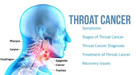 Throat Cancer Causes Symptoms And Effective Homeopathic Treatment
