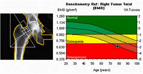 Osteoporosis And Bone Density Boca Radiology Group