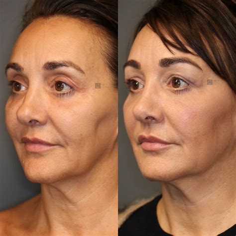 Patient 8560536 Thread Lift Before And After Clinic 5c