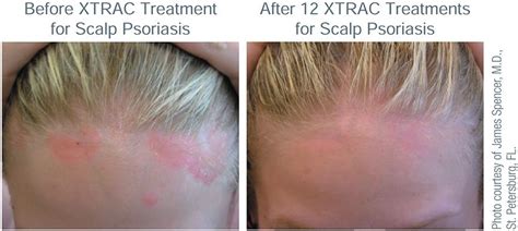 Xtrac Psoriasis Laser Advanced Dermatology And Cosmetic Surgery Center