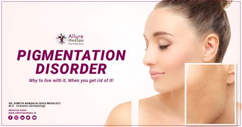 Pigmentation Disorders Types Symptoms And Treatments