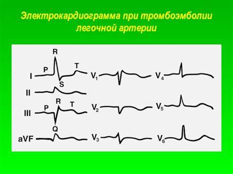 Диета при легочной тромбоэмболии Электрокардиография. Методика записи ЭКГ Электрокардиография. Методика записи ЭКГ Диета при легочной тромбоэмболии