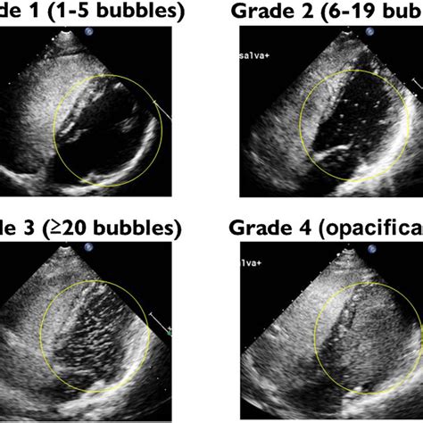 Patent Foramen Ovale Shunt Grading By A Transthoracic Echocardiographic