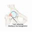 Hip Impingement Syndrome  Circle Integrated Care