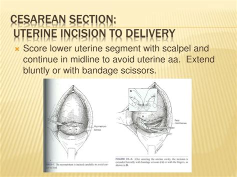 Ppt Cesarean Section Powerpoint Presentation Free Download Id1236509