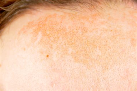 What You Dont Know About Melasma A Skin Condition Thats More Common