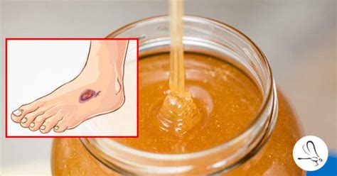 The 2 Best Natural Ingredients To Help Heal Sores Wounds And Ulcers