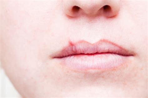 Herpes Cold Sore On Mouth Stock Photo Download Image Now Istock
