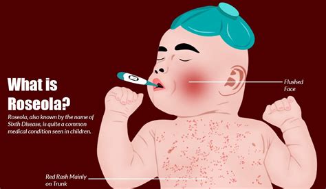 Roseola Causes Symptoms Treatment Complications