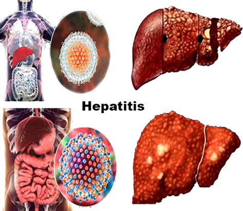Hepatitis Types Symptoms Causes Diagnosis Treatment And Prevention