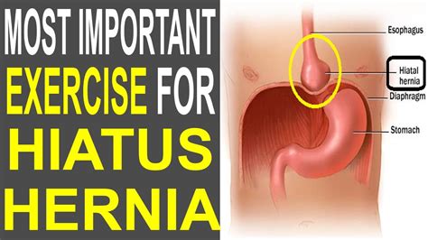 Most Important Exercise To Cure Hiatus Hernia HEALTH MADE EASY YouTube