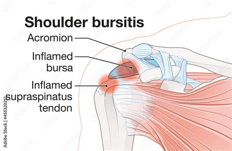 Shoulder bursitis Inflamed bursa and supraspinatus tendon Иллюстрация