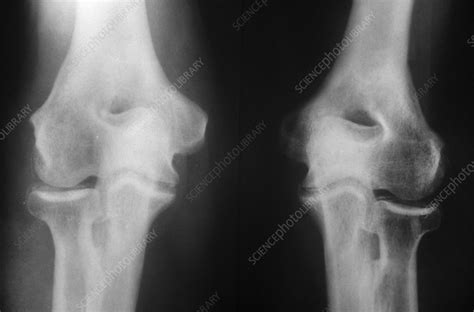Chondrocalcinosis X Ray Stock Image C0174603 Science Photo Library