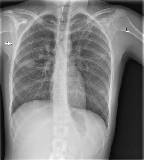 Tuberculosis Chest X Ray Findings