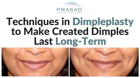 Dimple Creation Surgery Techniques Behind Long Lasting Created