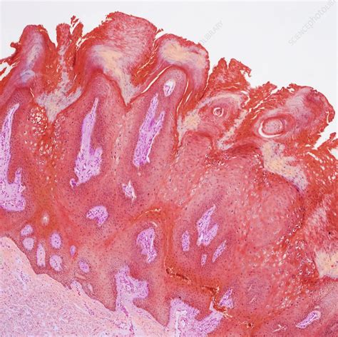 Viral Wart Lm Stock Image C0514715 Science Photo Library