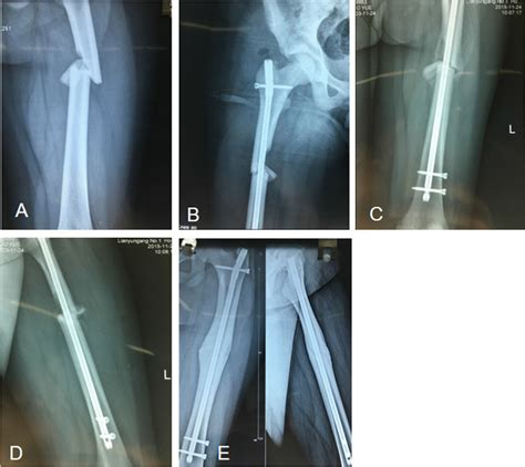 Example Of A Femoral Shaft Fracture Where The Degree Of Fracture Download Scientific Diagram