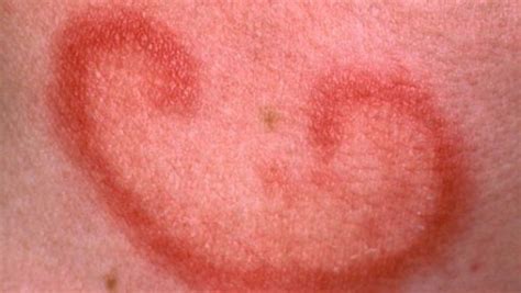 Common Skin Disorders In Toddlers And Adults