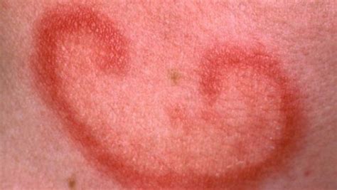 One common type of skin rash that affect people of all ages. Common skin disorders in toddlers and adults - VKool.com