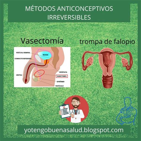 Vasectomía Y Trompas De Falopio Métodos Anticonceptivos Metodos