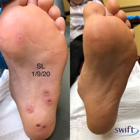 Dealing With Plantar Warts The Right Way General Podiatrist Located