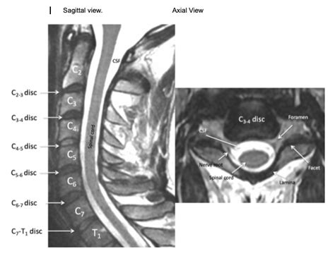 Cervical MRI Anatomy