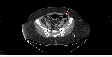 Ct Of The Abdomen And Pelvis Post Contrast Displaying A Left Spigelian