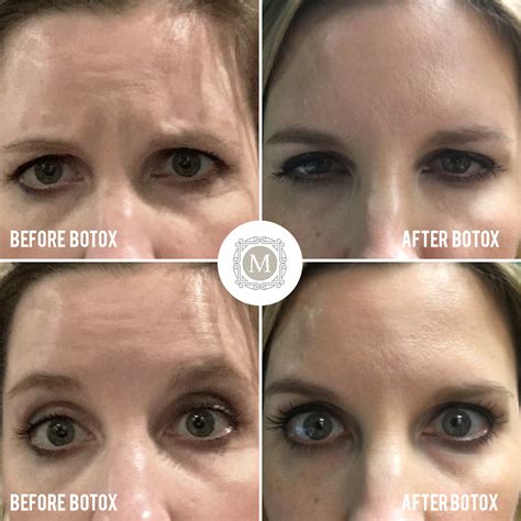 Botox Before And After 20 Units Before And After
