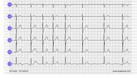 Ekg Practice Exams With Answers