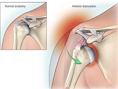 Shoulder Dislocations Part Recognition And Evaluation Orthopedic
