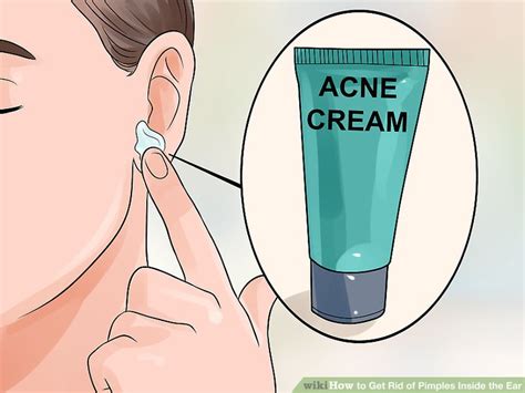 3 Ways To Get Rid Of Pimples Inside The Ear Wikihow