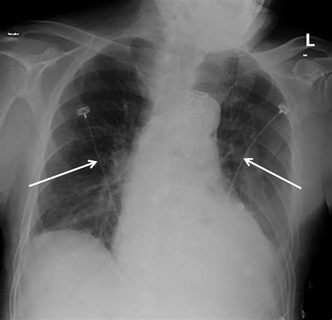 Cureus Optimizing Computed Tomography For Detection Of Pulmonary