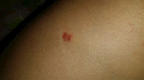 Redpurple Bump Ishflat Thing On My Leg Plz Hel My Skin