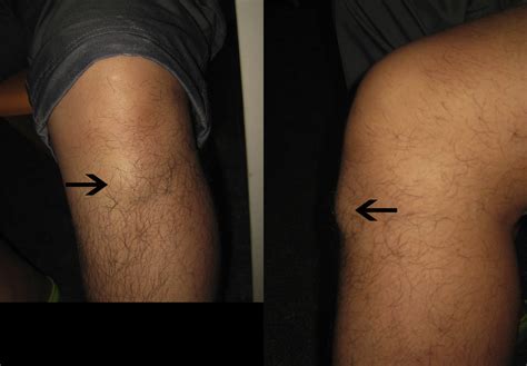 Endoscopic Resection Of Gouty Tophus Of The Patellar Tendon Arthroscopy Techniques
