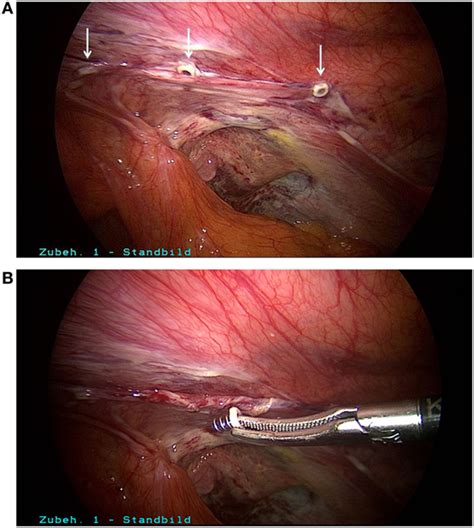 Surgical meshes are thin medical devices that are implanted in a person's body, usually the abdominal cavity, to repair and strengthen the damaged tissue. Frontiers | Early Surgical Intervention following Inguinal Hernia Repair with Severe ...