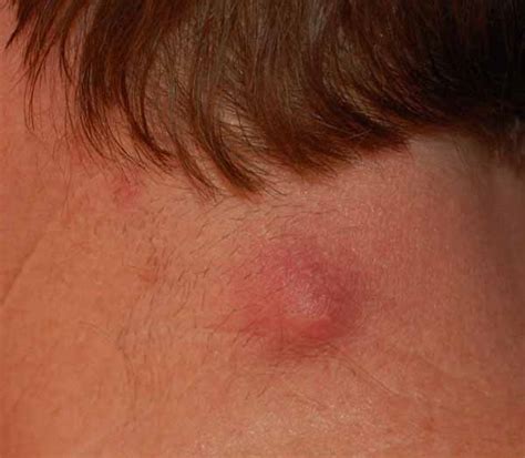 Sebaceous Cyst Treatment Skin Cyst Removal Kerala