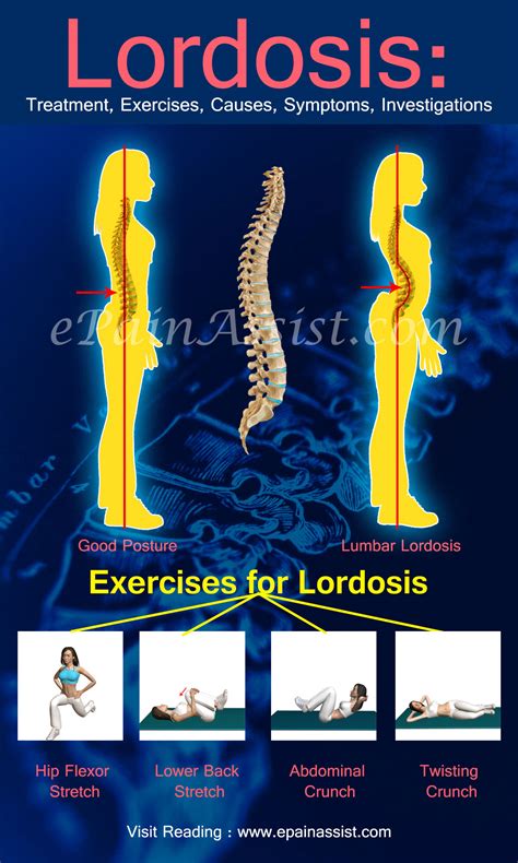Lordosis Treatment Exercises Causes Symptoms Investigations