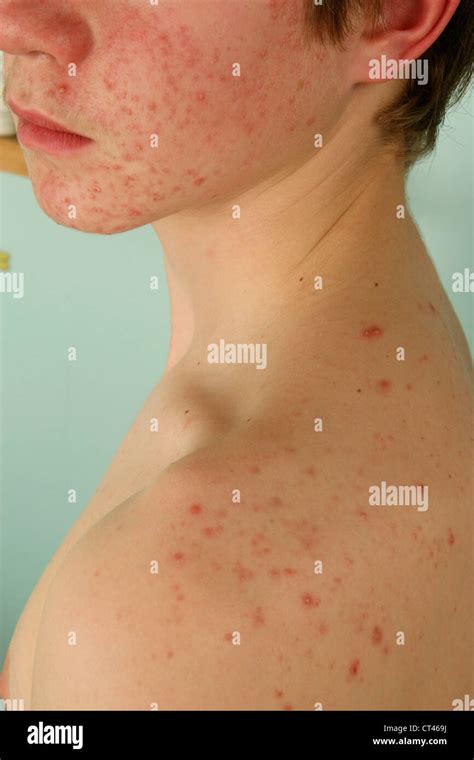 Teenage Boy Acne High Resolution Stock Photography And Images Alamy