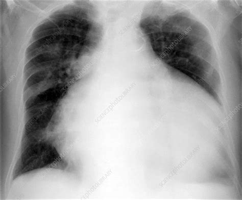 Enlarged Heart X Ray Stock Image F0356521 Science Photo Library