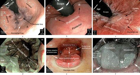 Anal Dysplasia Detection During Routine Screening Colonoscopy