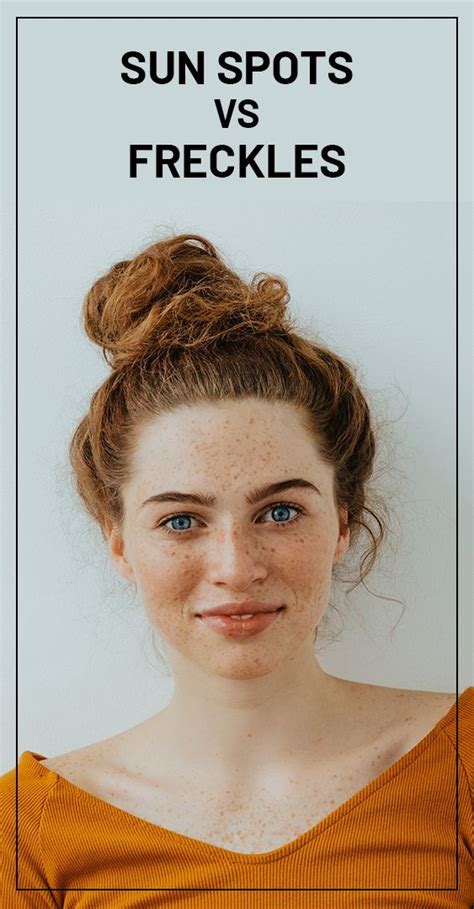 Freckles Are Tiny Spots Less Than 5 Mm In Diameter Where The Skin Cells Have Resulted In Extra