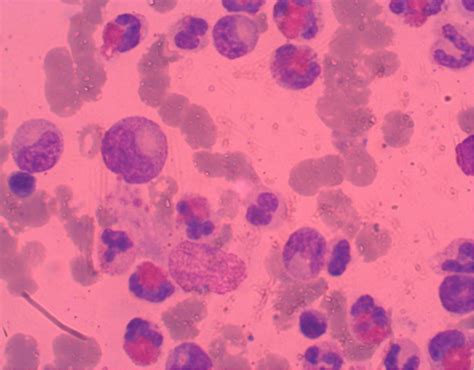 Juvenile Chronic Eosinophilic Leukemia A Variant Of Juvenile Chronic