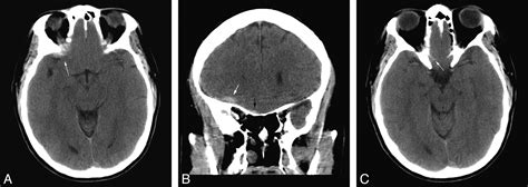 Value Of Coronal Reformations In The Ct Evaluation Of Acute Head Trauma