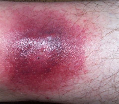Spider Bite Treatment How To Treat Spider Bites You Should Never Do This